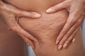 Living with Lipedema: Expert Tips for Coping and Care